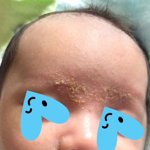 Kulit mati@ kuping dekat kening baby