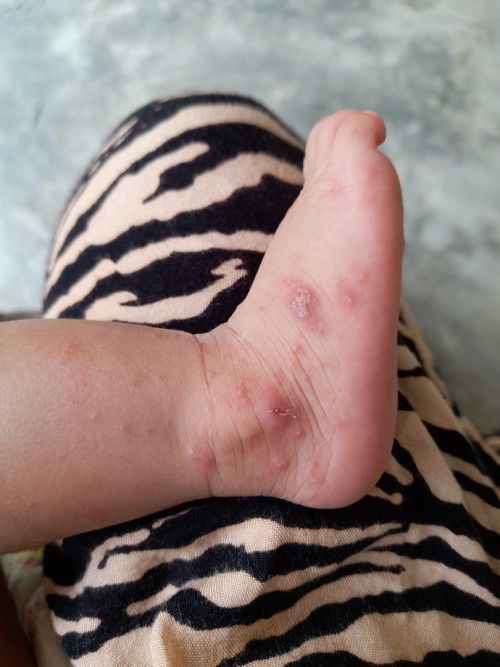 Mau tanya bun ini biang keringat atau alergi ya? Soalnya udah dipakein baby cream tapi belm kering²