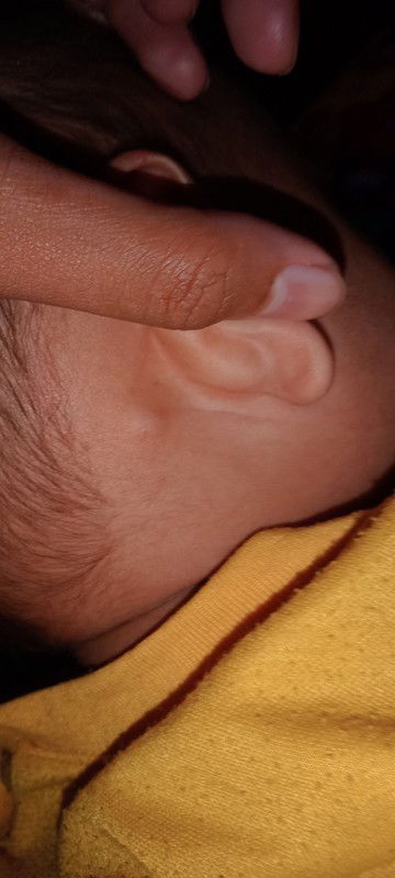 Benjolan belakang telinga dan demam.