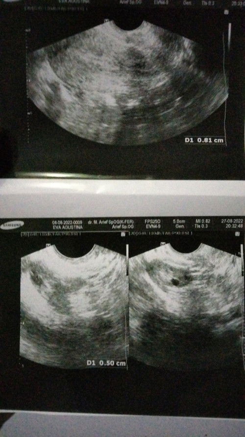 Saya keguguran disaat usia kandungan saya 8w 😭😭