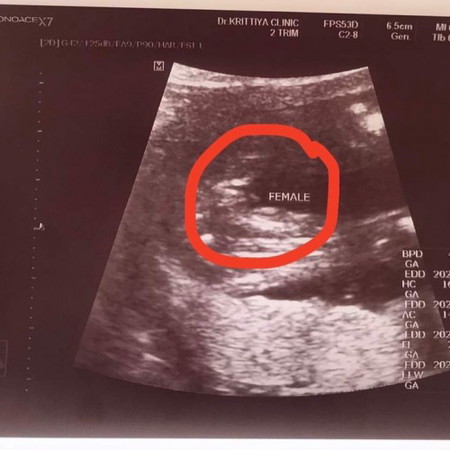 รูปภาพผลอัลตร้าซาว