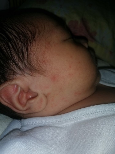 Rashes sa face ni baby 17days old