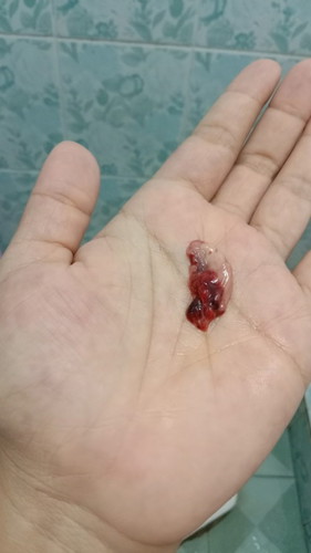 ปจด.ขาดไป12วัน ตรวจการตั้งครรภ์วันที่26/8ขึ้น2ขีดจางๆ วันที่27/8ตอนเย็นมีการอาการปวดท้องมาก เลือดออก