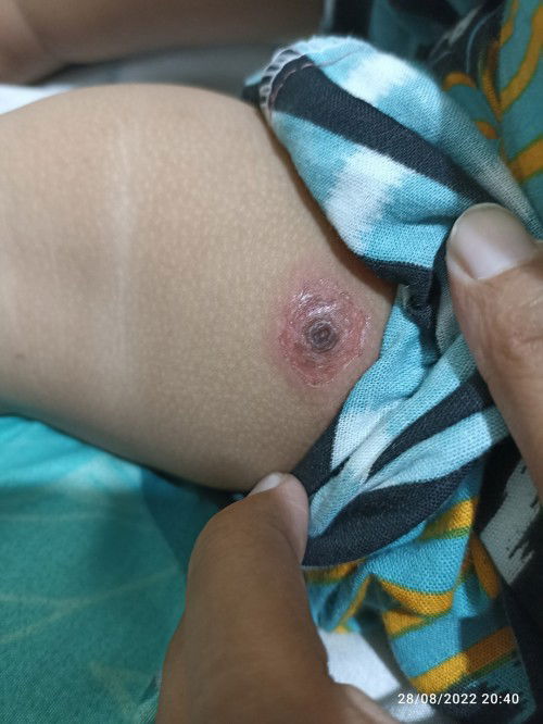 Suleten/suleden pada anak 1th