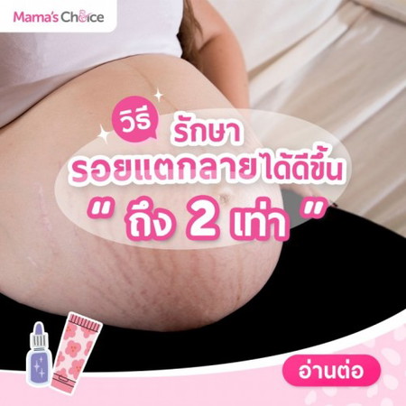 วิธีรักษารอยแตกลายได้ดีขึ้นถึง 2 เท่า