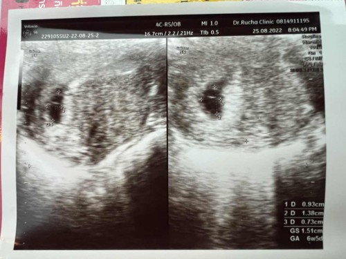 ไปซาวด์ตอน 8 วีค ซาวด์ผ่านหน้าท้องเจอถุงนิดเดียวแต่ยังไม่เจอน้อง อีก2สัปดาห์หมอนัดไปซาวด์ใหม่กลัวจะไม่เจอน้องเหมือนท้องแรก