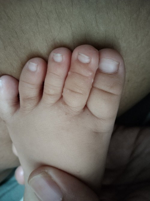 Gatal pada Kaki dan Pipi