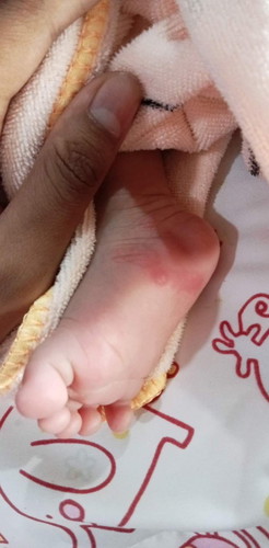 โดนมดกัดหรือมือเท้าปาก