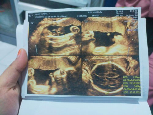 Hamil usia 28 mggu 4 hari