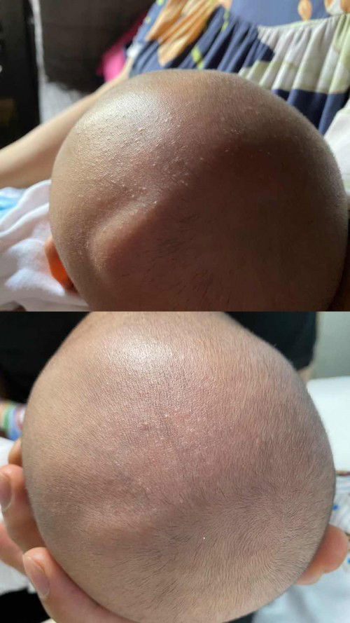 Kepala baby ada benjolan