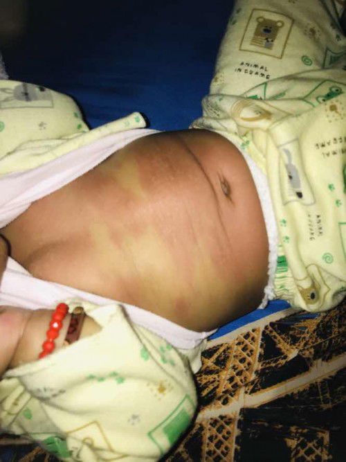 Bun mau tanya anak saya usia 7bulan, kulit anak saya seperti bentol2 kecil sangat bnyk sekali itu disebabkan karna apa