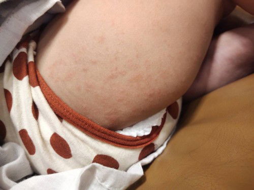 ขอสอบถามหน่อยค่ะพอดีน้องเป็นผื่นขึ้นแบบนี้ค่ะคันด้วยคะ