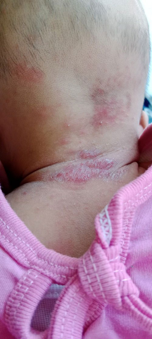 Merah merah pada leher