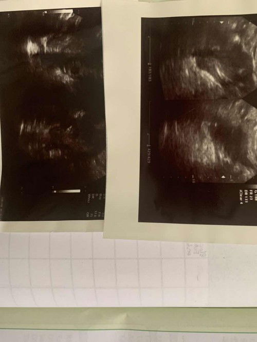 Ada pernah di vonis hamil di luar kandungan(ektopik) tapi ternyata tidak benar?