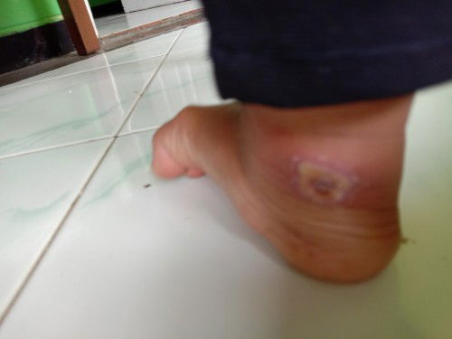 Hai bun, Mau tanya sedikit ni, kaki anak aku ada luka kyk gini kira" obat yang ampuh bisa cepet nyem