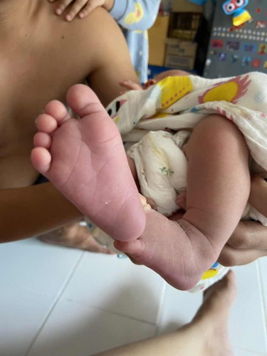ทารกมือเท้าม่วง