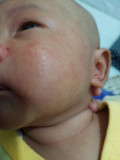 Merah di wajah baby 1 bulan