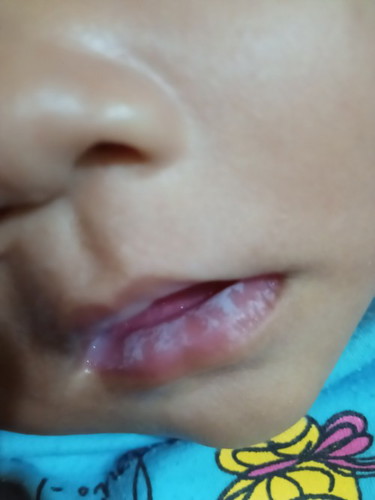 Lidah putih