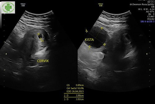 Makanan untuk ibu hamil 6 minggu