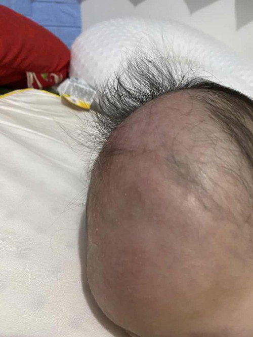 Kerak kepala bayi 4 bulan