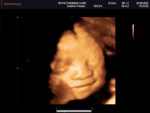 ตั้งครรภ์ 30 w แม่ๆ นน ขึ้นกันกี่โล แล้วค้า ลูกน้อย นน เท่าไหร่แล้วค้า