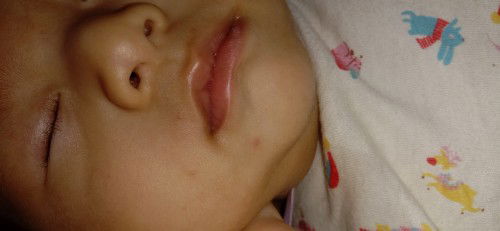 E xem thì mụn nay giống mấy mụn bé bị muỗi đốt nhưng kbt có phải k ạ e sợ bé bị tay chân miệng lắm