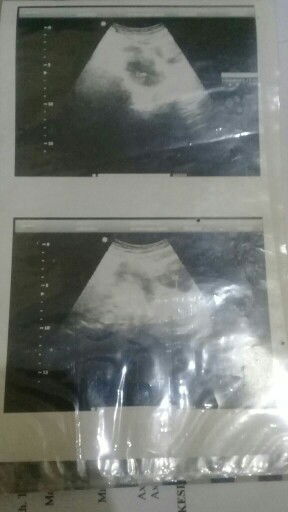 Ingin kepastian hasil usg dan segera hamil bisa mendapatkan momongan