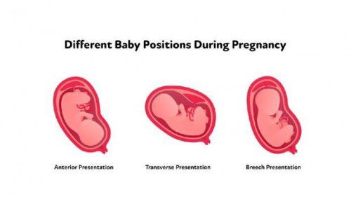 posisi janin melintang
