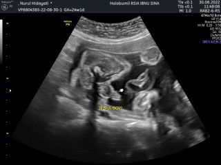 baby boy USG 6 bulan