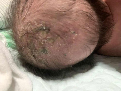 Langib sa ulo ni baby