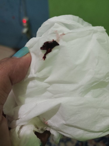 Kata dokter sya hamil bo, saat kencing sya liat celana ada darah bgini bun apakh sya hrus kuret ,