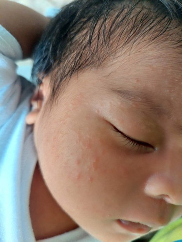 Baby Acne/Rashes