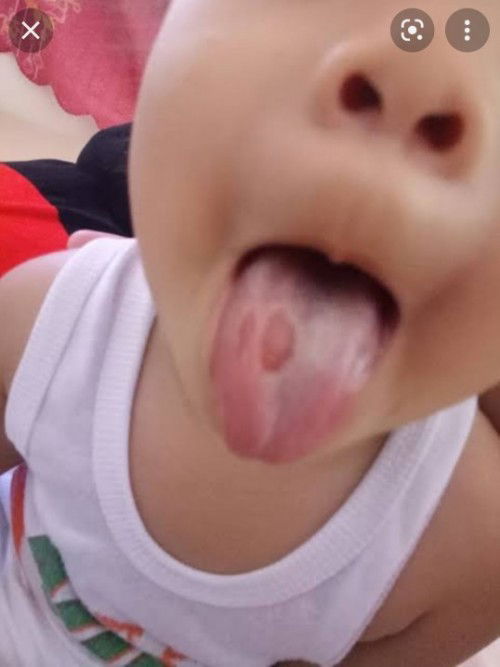 Spot sa Dila ng 2 yrs old Baby