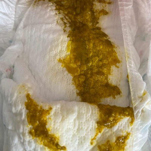 Is this considered diarrhea?