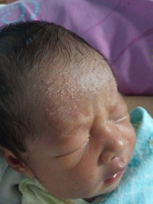 Bintik gelembung bening di jidat bayi