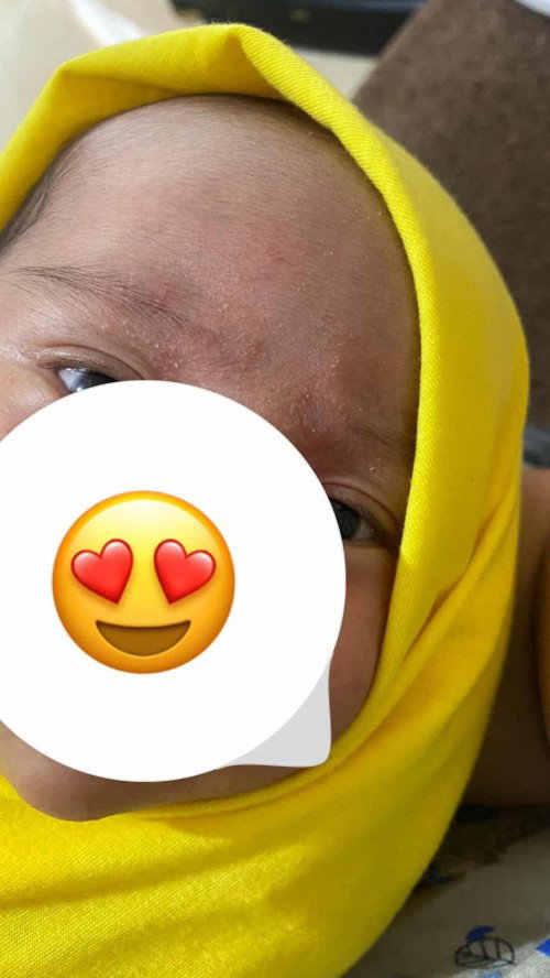 Kulit wajah bayi kering