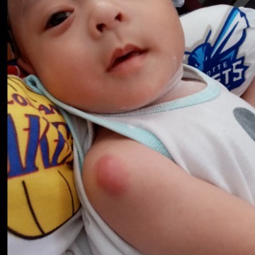 Bcg ni baby