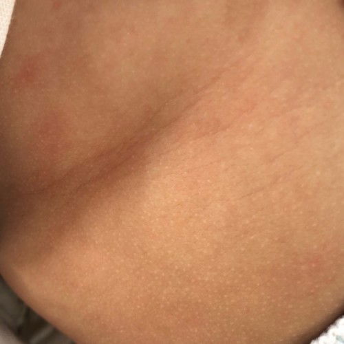 Kulit bintikan di perut