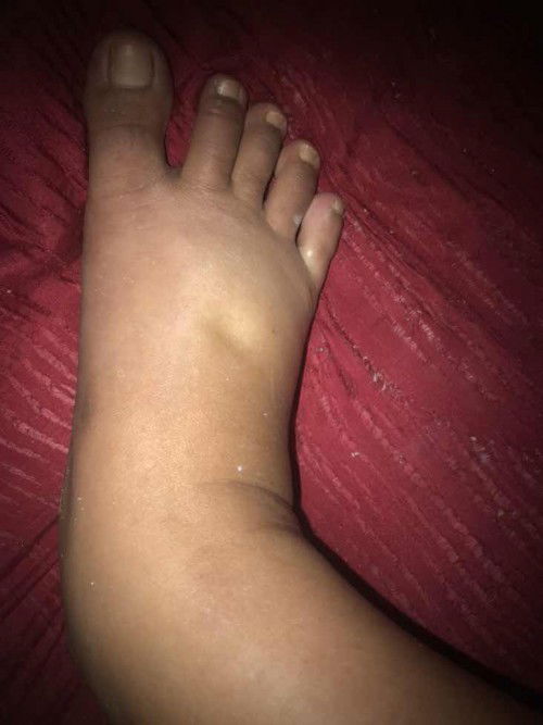 มาอัพเดทอาการกดแล้วบุ๋ม อาการบวม