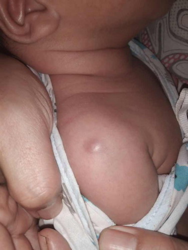 ไหล่ขวาของลูกมีตุ่มขึ้น เกิดจากสาเหตุอะไร ลูกอายุ 1 เดือน 24 วัน