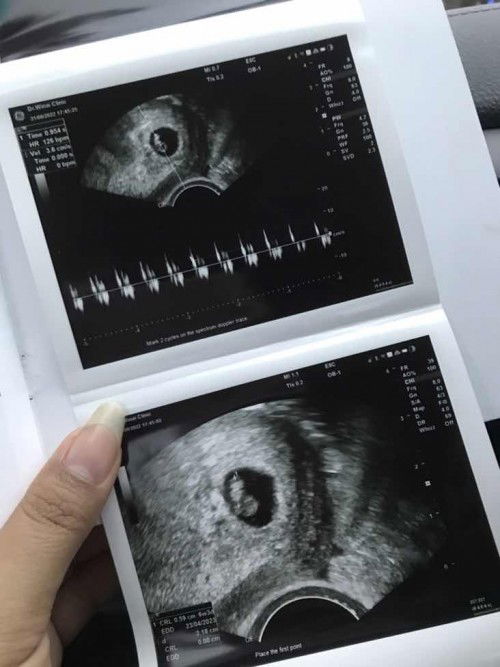 แม่ๆบ้านไหนเริ่มแพ้ท้องแล้วบ้างค่ะ   6w3dบ้านนี้ยังไม่มีค่ะหิวอย่างเดียว