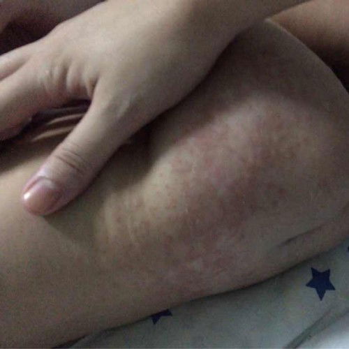 Pahelp naman po Rashes ni lo