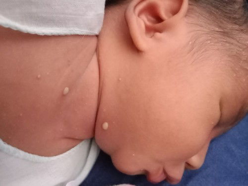 ลูกมีตุ่มหนองขึ้นตามตัวขาแขนหัว