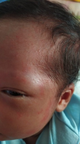 Bun mau tanya ini ruam atau alergi ya, bintik2 mersh sampai di kepala, klo di badan gak ada