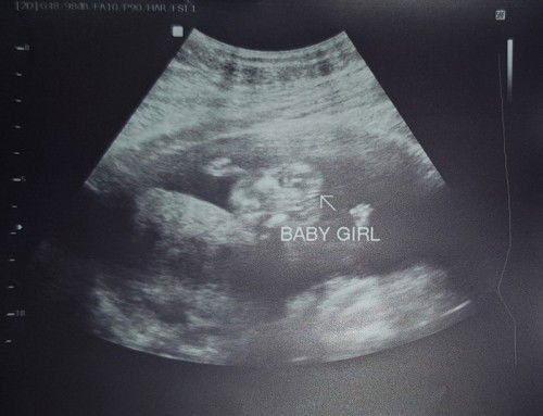 Gender Ultrasound 4months