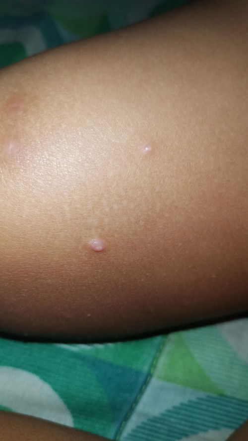 Hello mga momsh, may nakakaalam po ba sa inyo kung ano yang butlig nasa hita ng baby ko.