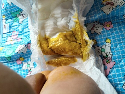 Normal ba na ganito poop ni baby