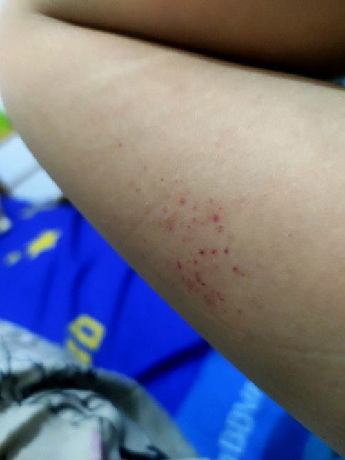 Gatal saat hamil 18week