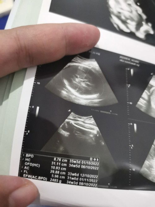 Usia di hasil usg beda2