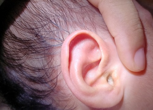 Discharge sa tenga ni baby ko na 1month old